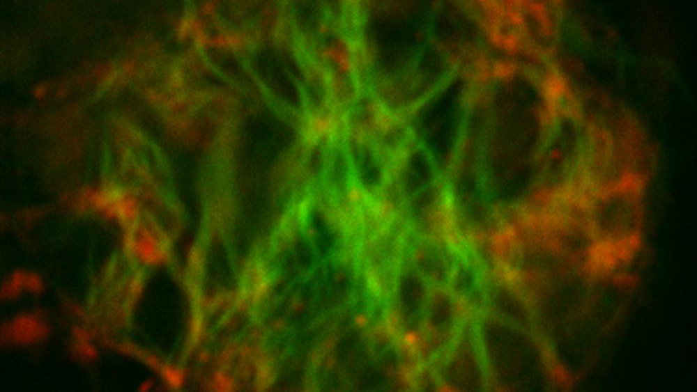 A single Alzheimer's disease plaque - the green shows fibrils and the red shows other assembly states of a protein called beta-amyloid